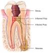 Photo for Root Canal Treatment
