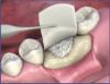 Photo for Oral Cavity Repair Membrane Market Analysis and Value Forecast Snapshot by End-use Industry 2019-2025