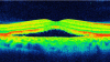 Photo for Optical Coherence Tomography Market Worth $2,179.75 Million by 2026