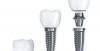 Photo for Parallel Walled Dental Implant Market – Global Industry Trend Analysis 2019 to 2018 and Forecast 2019 – 2025