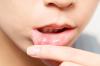Photo for Mouth Ulcer Treatment Market: Global Sales, Ex-factory Price, Revenue, Gross Margin Analysis 2026