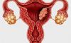 Photo for Uterine Cancer Drugs Market - Trends, Size, Share, Outlook, and Opportunity Analysis, 2018-2026