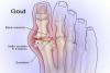Photo for Gouty Arthritis Market Global Industry Insights, Trends, Outlook, and Opportunity Analysis, 2018-2026