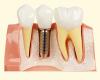 Photo for Dental Crowns in Zirakpur