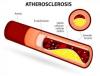 Photo for Atherosclerosis Market 2018-2025 Industry Outlook Research Report By DecisionDatabases