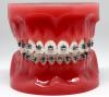 Photo for Self Ligating Bracket Sales Market Study By Type, Application & Top Key Players - BioMers Pte Ltd., Orthodontic Products, G&H® Orthodontics, Ormco Corporation