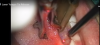 Photo for Laser Frenectomy Cost in Tongue Tie Surgery  Sydney