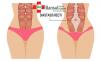 Photo for Diastasis Recti Treatment | Diastasis Recti Treatment in India