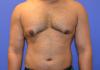 Photo for Best Gynecomastia Surgery In Delhi | Gynecoamstia Treatment | Call Now +919210000084