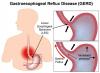 Photo for Gastroesophageal Reflux Disease (GERD) Treatment Devices Market Positioning and Growing Market Share Worldwide