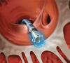Photo for Ablation Devices Market Outlook, Opportunity and Demand Analysis, Forecast 2014 – 2022