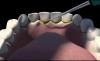 Photo for Ultrasonic Dental Scalers Market - Size, Share and Opportunity Analysis, 2018 – 2026