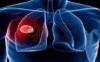 Photo for Lung Cancer Therapeutics Market is Poised To Achieve Continuing Growth 2026