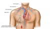 Photo for U.S. Central Venous Catheter Market Business Segmentation by Revenue, Market Landscape, Present Scenario and Growth Prospects 2026