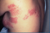 Photo for Shingles Treatment Market Report 2018-2025 Product Scope & Key Players - Astellas Pharma, Beijing Minhai Biotechnology Co., Epiphany Biosciences, Foamix Ltd., GeneOne Life Science, Inc.