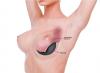 Photo for Get Treatment For Breast Implants In Dubai
