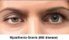 Photo for Myasthenia Gravis Treatment Market Regional Analysis and future forecast 2027