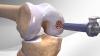 Photo for Knee Cartilage Repair Market Projected to Grow Steadily During 2018-2026