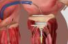 Photo for Transcatheter Mitral Valve Repair and Replacement Market - Size, Share, Outlook, and Opportunity Analysis 2018 – 2026