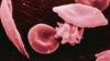 Photo for Global Sickle Cell Anemia Market | Industry Outlook Research Report 2018-2025 By DecisionDatabases