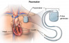 Photo for Check The Pacemaker Surgery Cost In India - Credihealth