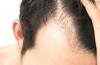 Photo for Alopecia Treatment Market to Surpass US$ 12.1 Bn Threshold by 2026