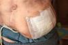 Photo for Colostomy Bags Market Major Players Swot Analysis 2019