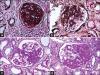 Photo for Focal Segmental Glomerulosclerosis Market - Size, Share, Outlook, and Opportunity Analysis 2018 – 2026