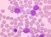 Photo for Mantle Cell Lymphoma Treatment Market: Moving Towards a Brighter Future 2018-2026