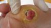 Photo for Diabetic Neuropathy Market Size & Share to See Modest Growth Through 2026