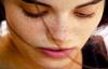 Photo for Treatment of Melasma