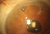 Photo for Novel Drugs and Devices to Lower Intraocular Pressure Market To Register Unwavering Growth During in Global by 2026