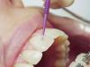 Photo for Dental Adhesives and Sealants Market Report - 3M, Baxter International, DENTSPLY International, Johnson & Johnson, Mitsui Chemicals