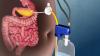 Photo for Surgical Drainage Devices Market Foreseen To Grow Exponentially Over 2026