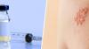 Photo for Shingles Vaccine Market - Trends, Outlook, and Opportunity Analysis, 2018-2026
