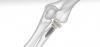 Photo for Modular Anatomic Reconstruction Market: Adoption of Innovative Offerings to Boost Returns on Investment