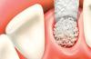 Photo for Latin America Bone Graft and Substitutes Market is Booming Worldwide till 2026