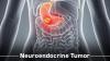 Photo for Neuroendocrine Tumor Treatment Market Witness Considerable Growth To 2026
