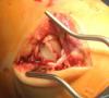 Photo for Autologous Matrix-Induced Chondrogenesis Market Growth & Estimation, 2025 | Anika Therapeutics, Inc., Arthro-Kinetics, B. Braun Melsungen AG, BioTissue AG, CartiHeal