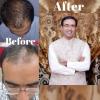 Photo for FUE Hair Transplant In Lahore | Hair Restoration In Lahore