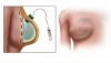 Photo for Tissue Expander Market Study By End-Use, Shape, Application & Top Key Players - Allergan plc, GC Aesthetics, GROUPE SEBBIN SAS, Guangzhou Wanhe Plastic Materials Co., Ltd., KOKEN CO., LTD.