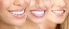 Photo for Best Dental Implant in Ahmedabad