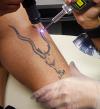 Photo for Tattoo Removal Devices Market | Industry Outlook Research Report 2018-2025 By DecisionDatabases