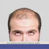 Photo for Hair Replacement Hyderabad