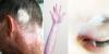 Photo for Vitiligo Drugs Market Size and Analysis by Leading Manufacturers with Its Application