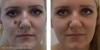 Photo for Mole Removal Treatment in Dubai
