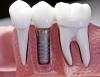 Photo for Intramucosal Implants Market - Size, Trends, Outlook, and Opportunity Analysis, 2018 – 2026