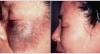 Photo for Pigmented Lesion Treatment Market, By Laser Type,End User, and Region Insights, Trends,nalysis, 2018-2026