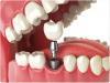 Photo for Dental Prosthetics Market Report Study, Synthesis and Summation 2018-2026