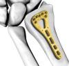 Photo for Orthopedic Implants Market Size and Forecasts Research Report 2018-2026